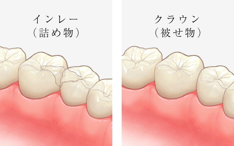 セラミック / インレー・クラウン