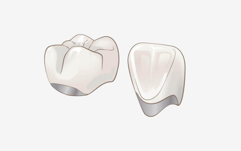 メタルボンド / クラウン