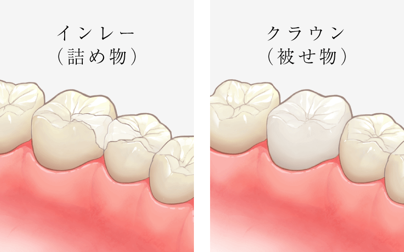 ジルコニア / インレー・クラウン