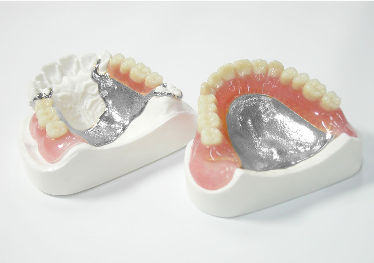 金属床義歯