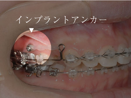 インプラントアンカーを使用した矯正