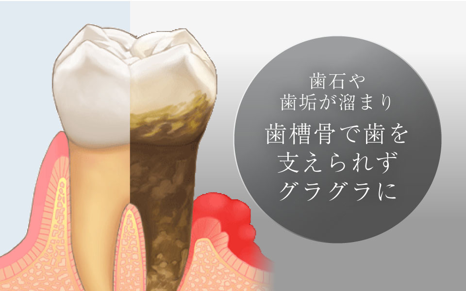 歯石や歯垢が溜まり歯槽骨で歯を支えられずグラグラに