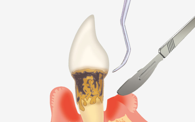 歯周外科治療